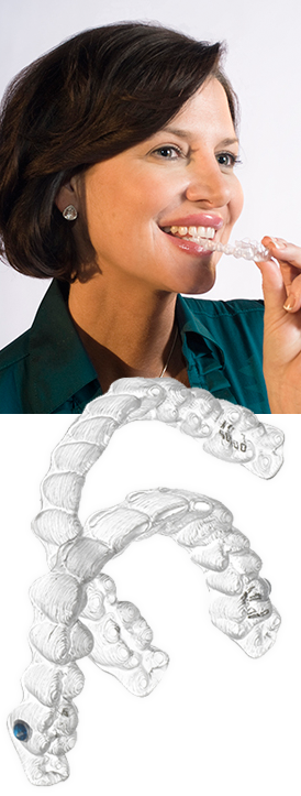 How does Invisalign Work?